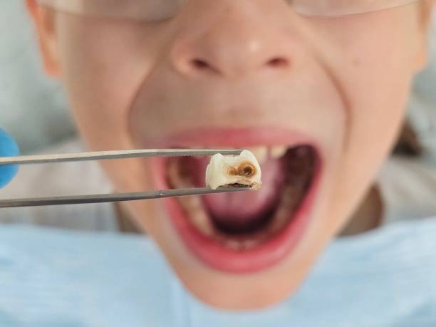 Best Emergency Treatment for Dental Infections or Abscesses in Paw Paw, MI